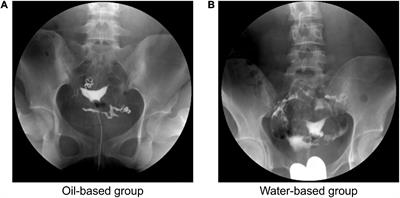 Fertility-enhancing effect of oil-based contrast agents during hysterosalpingography and the variation of this effect within a 3-year follow-up period in infertile patients